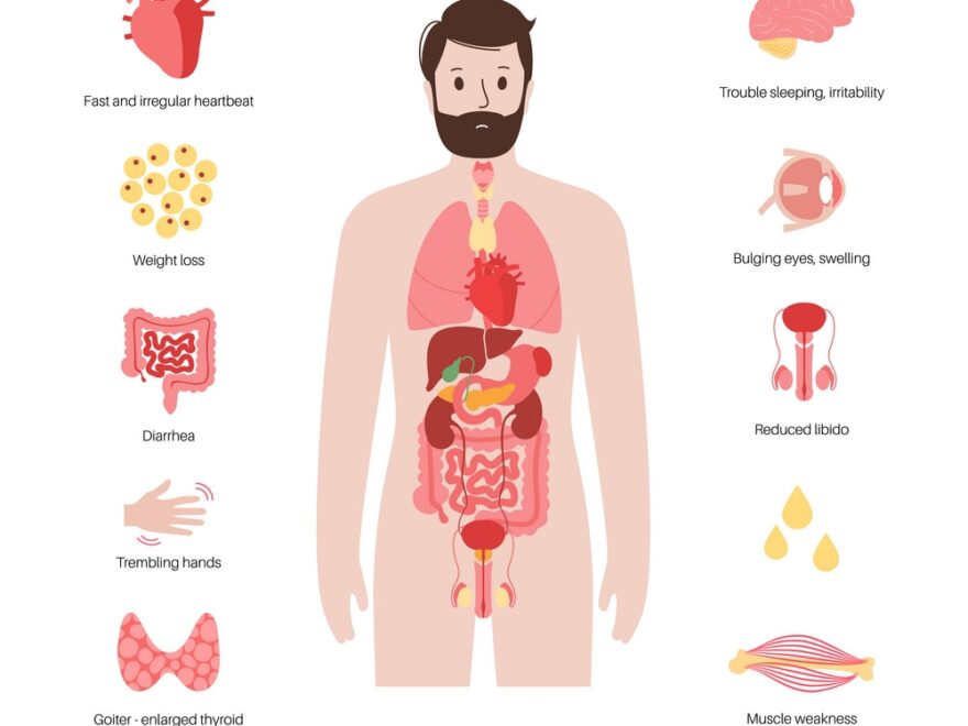 Graves Disease Symptoms Royalty Free Vector Image
