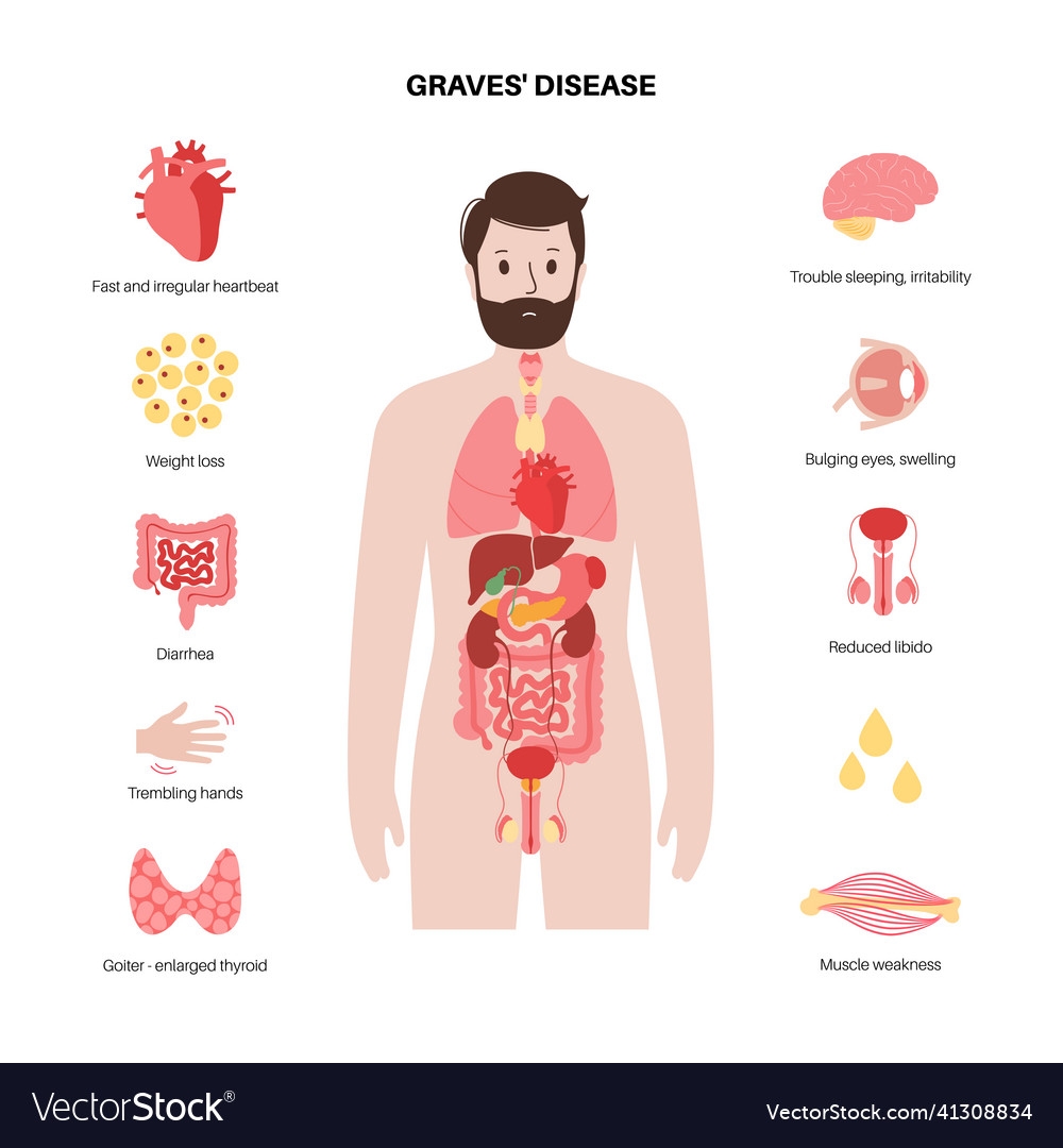 Graves Disease Symptoms Royalty Free Vector Image