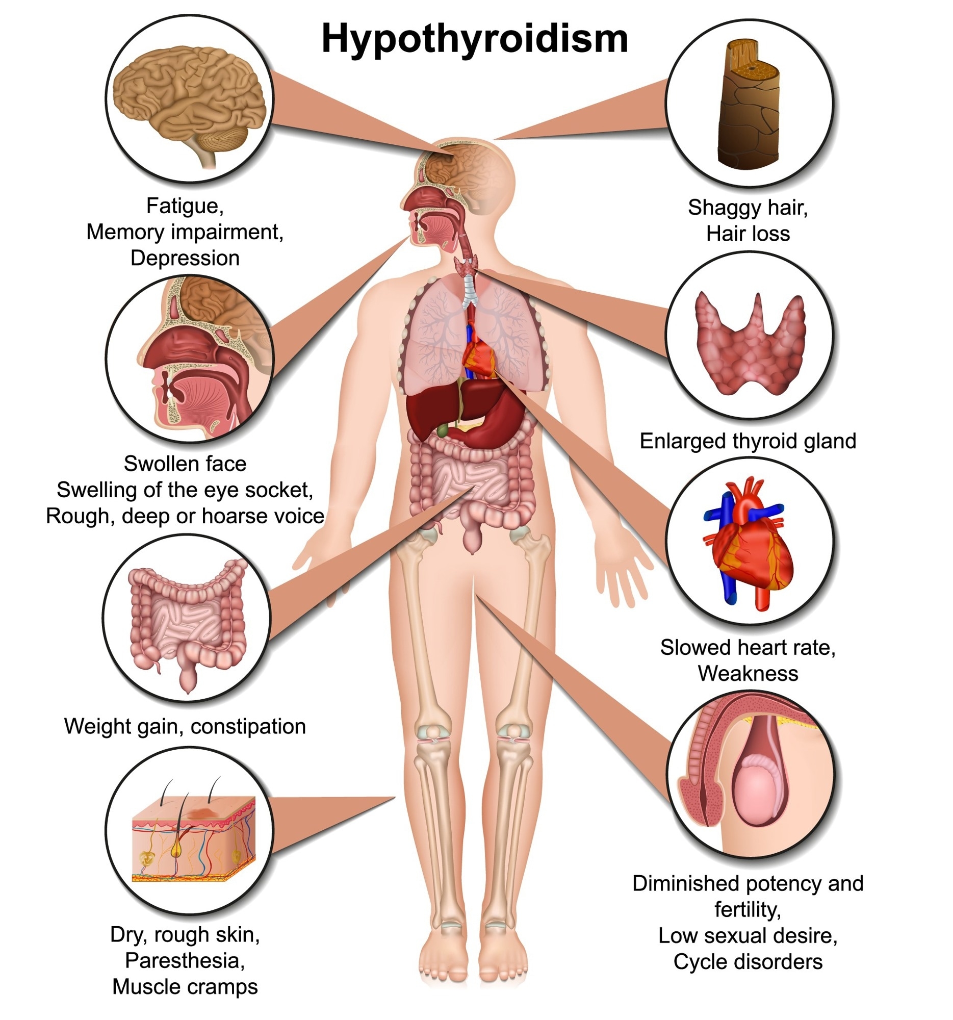 Hyperthyroidism Diagnosis