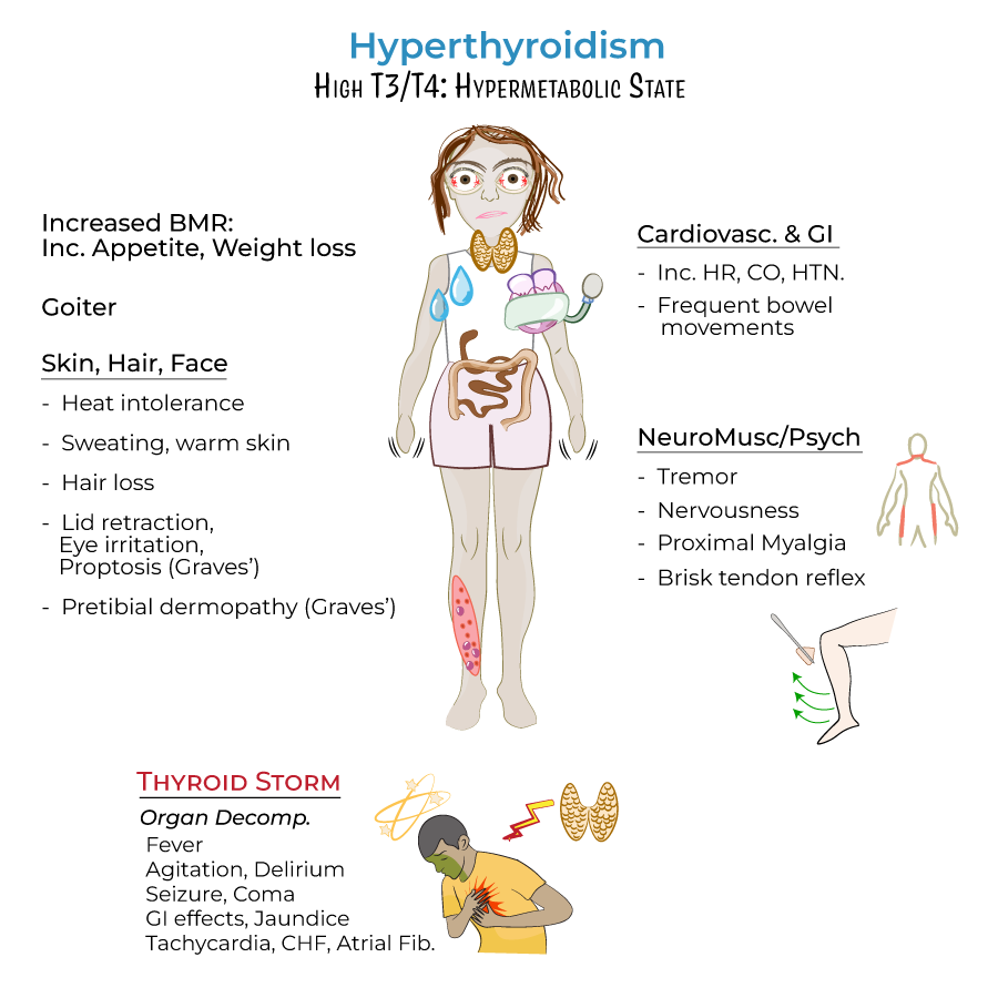 Hyperthyroidism Graves Disease Others Clinical Pathology Flashcards Ditki Medical And Biological Sciences